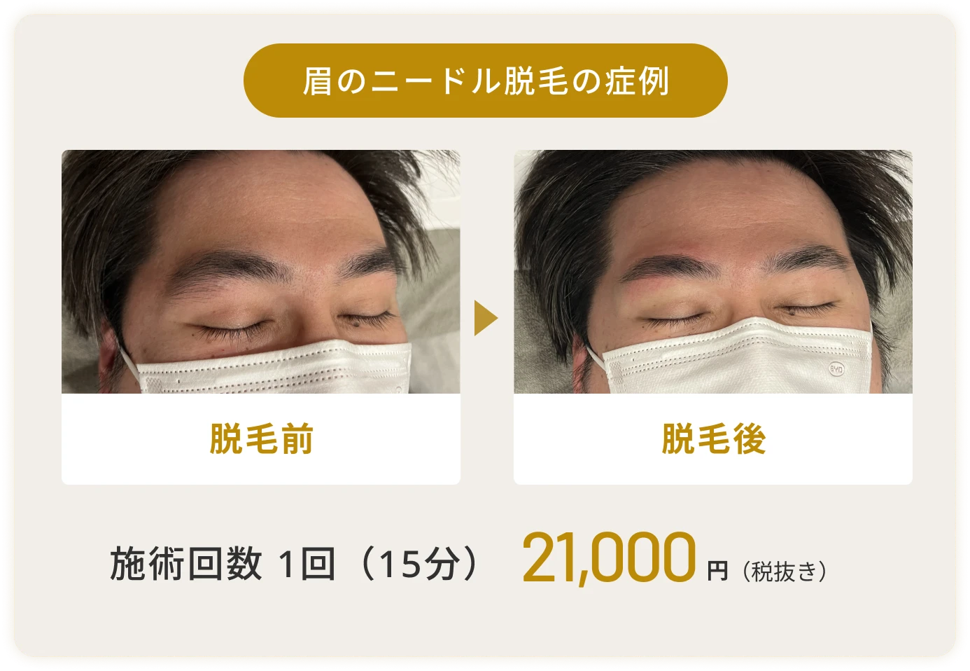 眉のニードル脱毛の症例写真