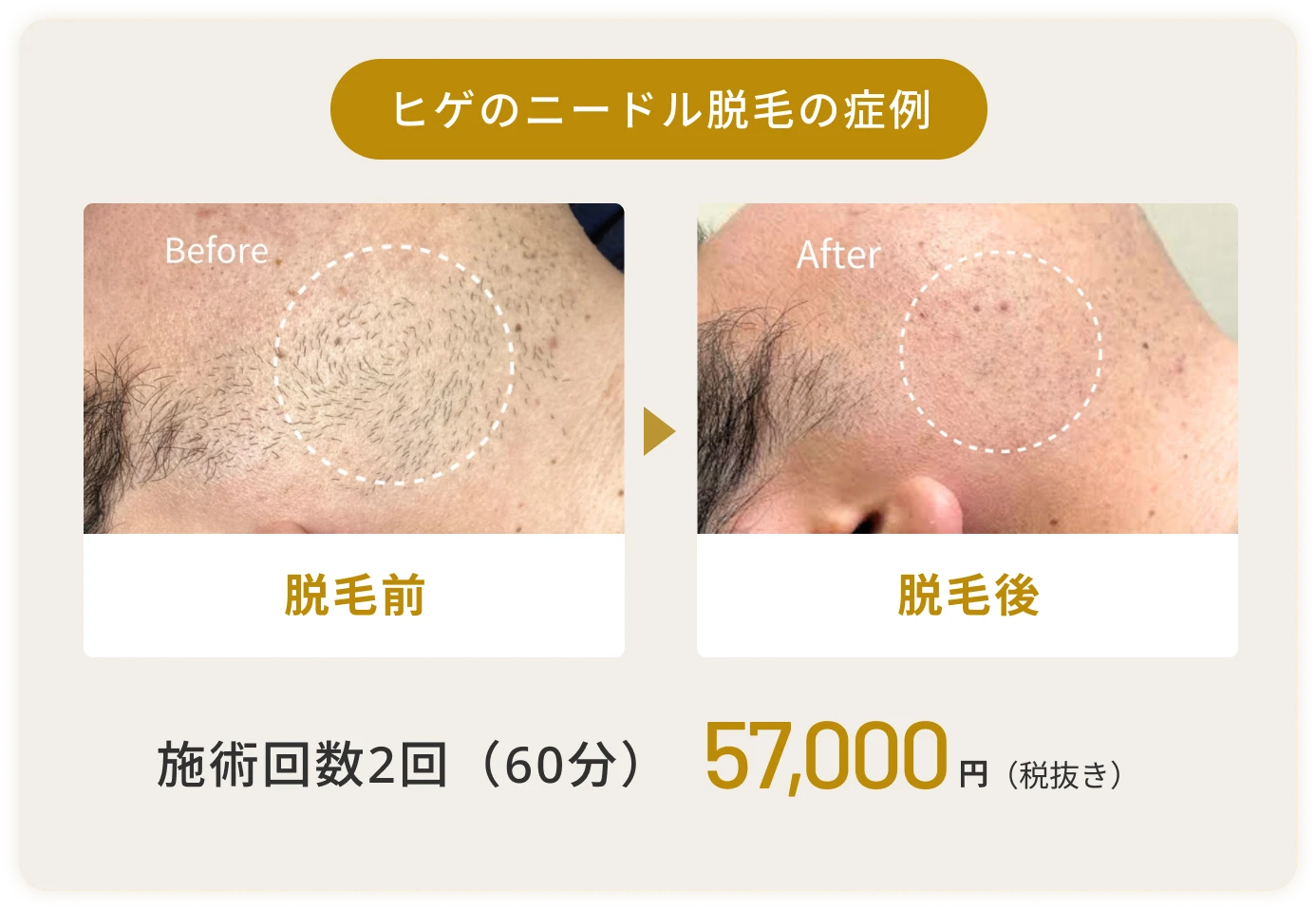 ヒゲのニードル脱毛の症例