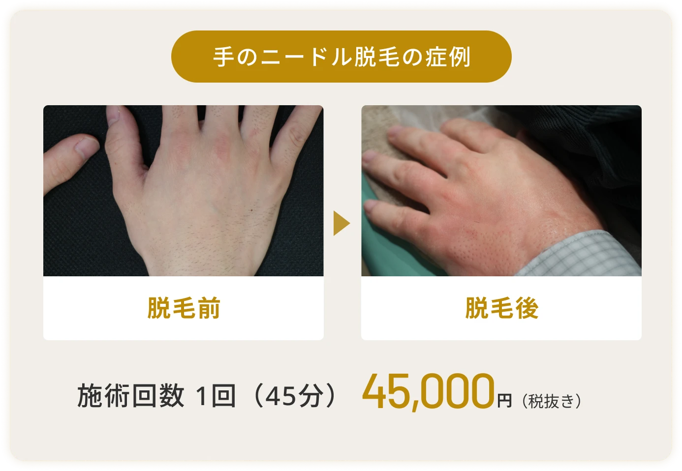 手のニードル脱毛の症例