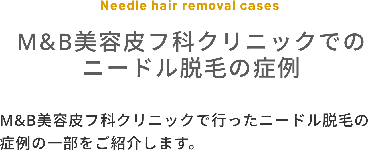 M&B美容皮フ科クリニックでの
            ニードル脱毛の症例