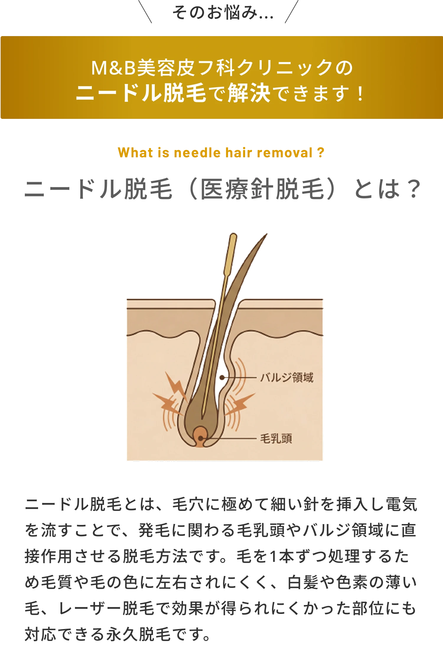 ニードル脱毛の紹介