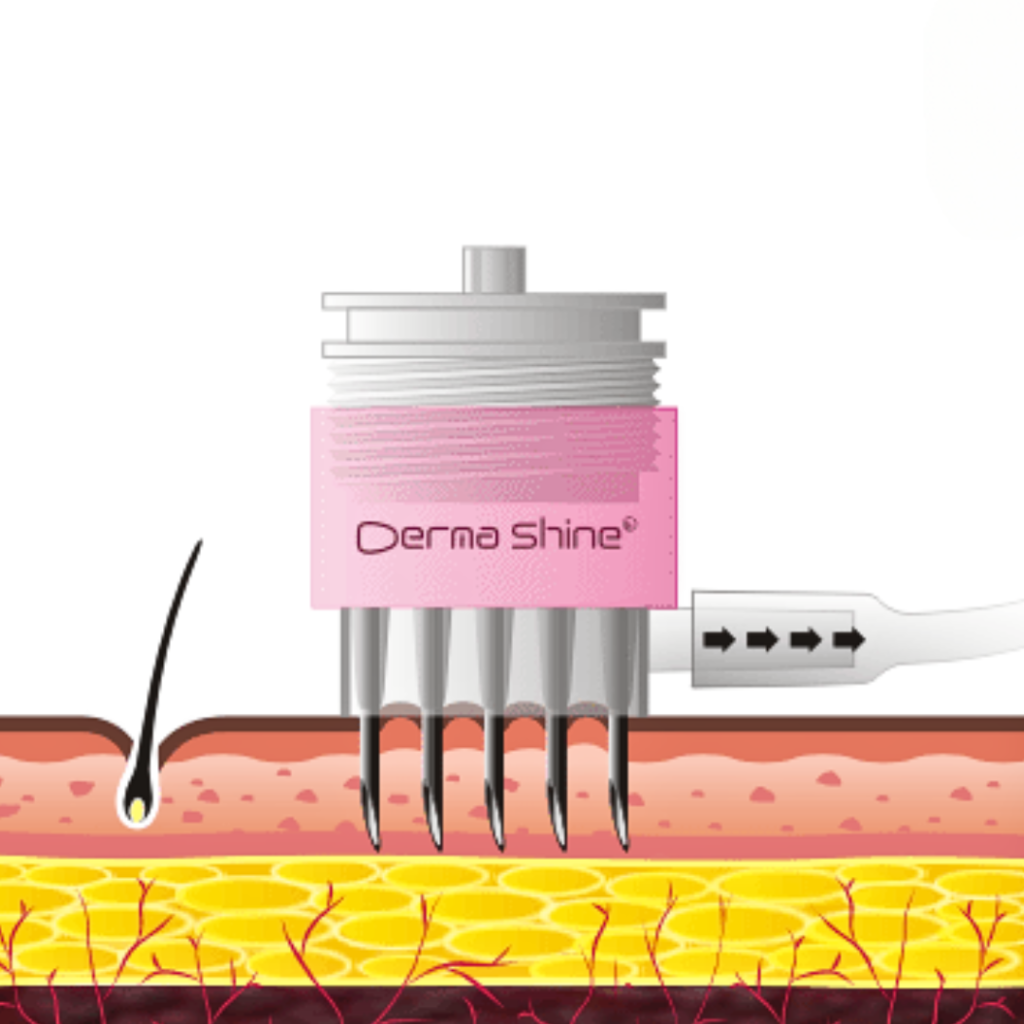 美容成分を真皮層に直接注入