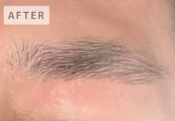 眉毛の症例写真1 After