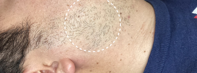 ヒゲ脱毛 症例写真1 Before