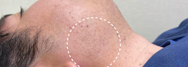 ヒゲ脱毛 症例写真1 After