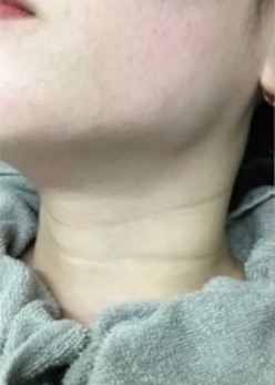 リジュラン症例 Before