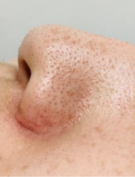 症例1 鼻 施術前