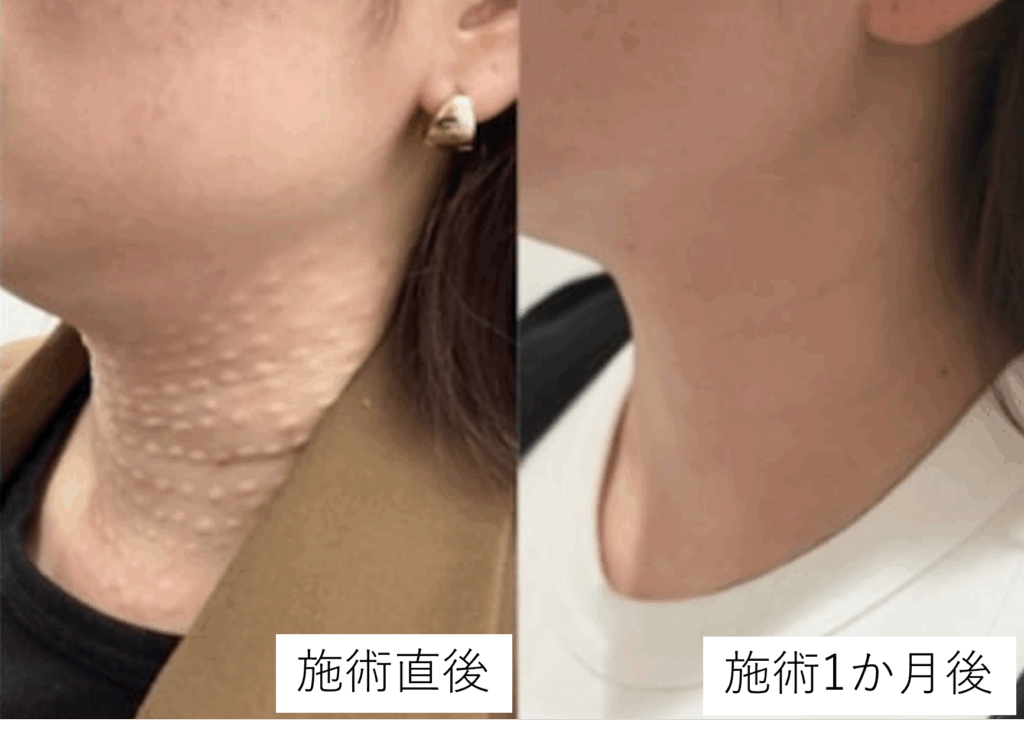 リジュラン症例 After