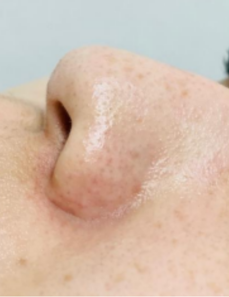 症例1 鼻 施術後