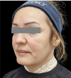 ジャルプロ治療前