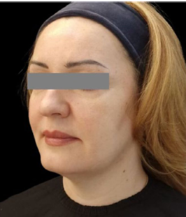 ジャルプロ治療後