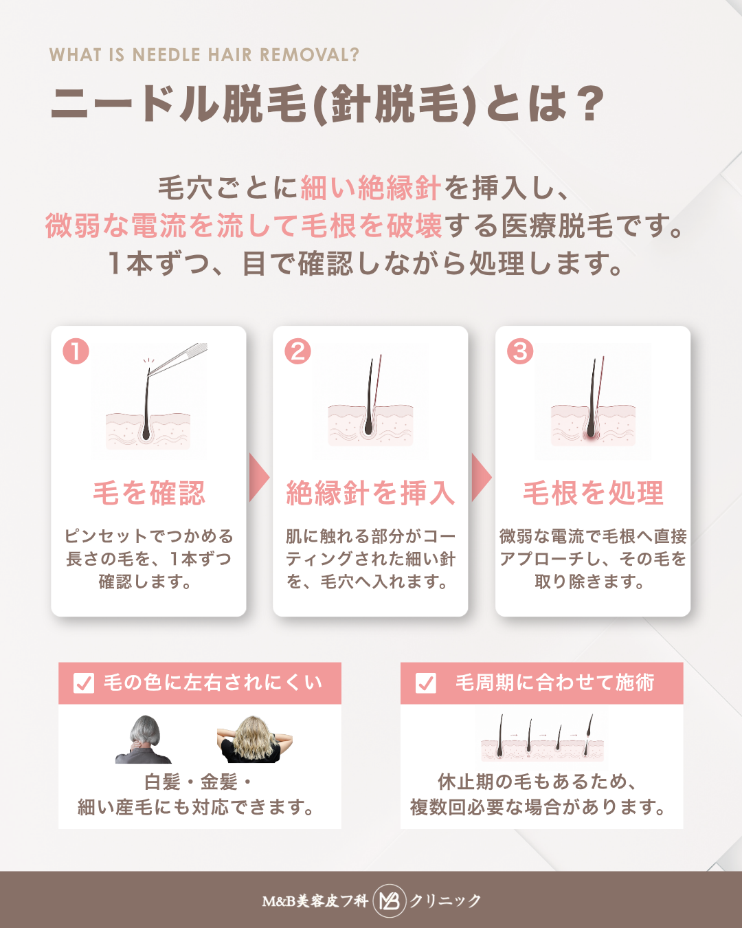 ニードル脱毛（針脱毛）とは？ 白髪・産毛・レーザー後の残り毛を1本